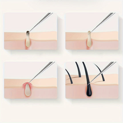 Blackhead Remover Tool Stainless Steel, Whitehead Remover – image 5