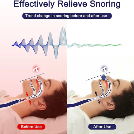 Anti Snoring Device, Sleep Apnea Device for Travel – image 4