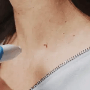 Aero Tag Remover Kit | Pain-Free Skin Tag Solution 1