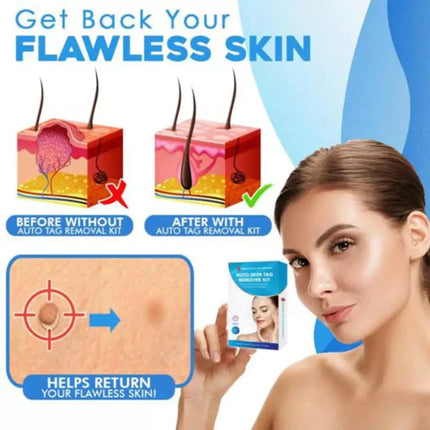 Aero Tag Remover Kit | Pain-Free Skin Tag Solution 5