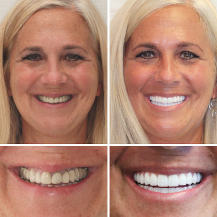 Complete Dentures Set | Natural Appearance with Tailored Fit | Comfortable Solution for Enhanced Confidence 4