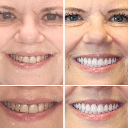 Complete Dentures Set | Natural Appearance with Tailored Fit | Comfortable Solution for Enhanced Confidence 5