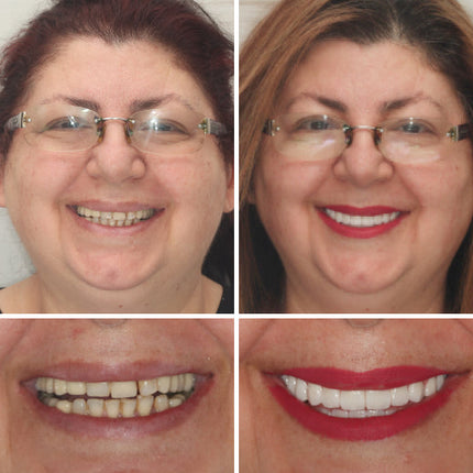 Complete Dentures Set | Natural Appearance with Tailored Fit | Comfortable Solution for Enhanced Confidence 6