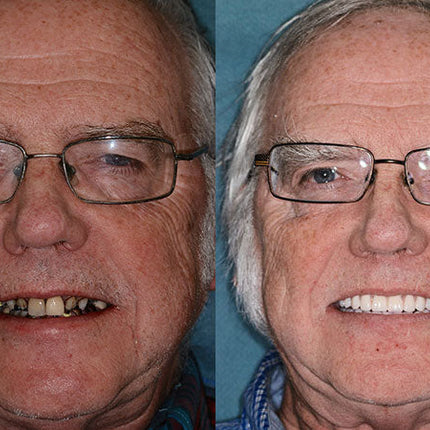 Complete Dentures Set | Natural Appearance with Tailored Fit | Comfortable Solution for Enhanced Confidence 7