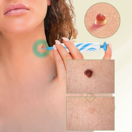 DermaLinx | Wart Remover for Pain-Free Skin Treatment | Effective Solution for Smooth Skin 0