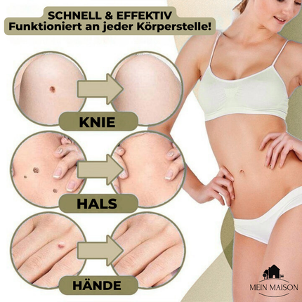 DermaLinx | Wart Remover for Pain-Free Skin Treatment | Effective Solution for Smooth Skin 3