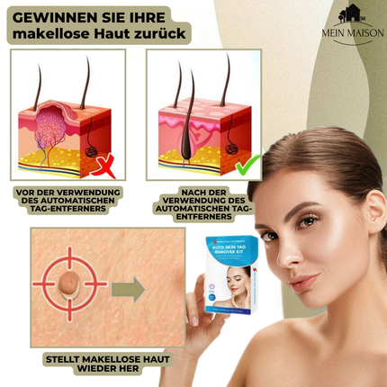 DermaLinx | Wart Remover for Pain-Free Skin Treatment | Effective Solution for Smooth Skin 4