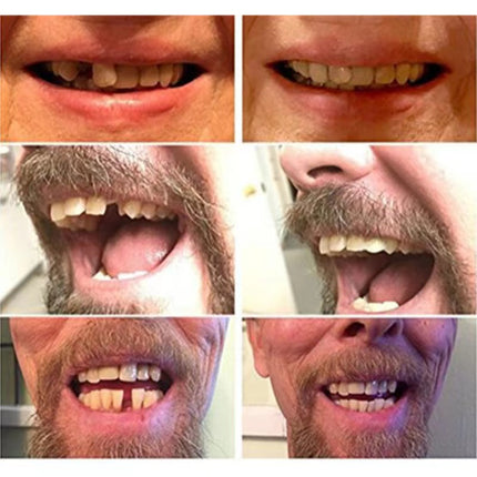 High-Quality Temporary Dentures | Natural-Looking False Teeth for Comfortable Confidence 2