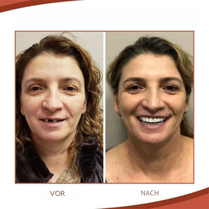 Fake Teeth, Removable False Teeth Set for Instant Natural Smile, Denture Style Teeth Cover, Temporary Dentures