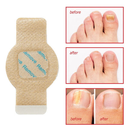 Nail Repair Patches for Toenails and Fingernails, Nail Care for Discolored Nails – image 5