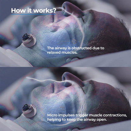 Smart Anti Snore Device | Wearable Chin Clip with Snore Detection | Comfortable Sleep Aid for Quieter Nights 1