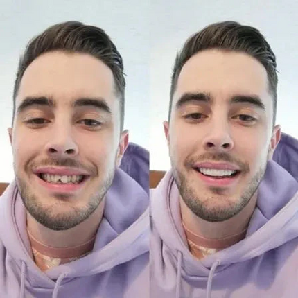 Smile Enhancer | Upper and Lower Tooth Covers with Realistic Design | Comfortable Fit for Instant Confidence 3