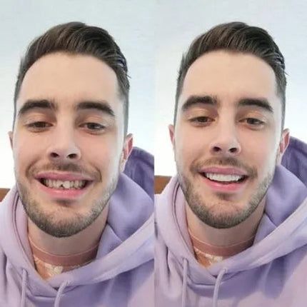 Smile Transformation | Removable Veneers Set for Natural Look & Comfort | Perfect Solution for Your Smile 2