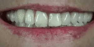 Snap-On Veneers Set for Upper & Lower Teeth with Custom Fit | Removable Solution for a Natural-Looking Smile 2