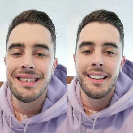 Snap-On Veneers Set for Upper & Lower Teeth with Custom Fit | Removable Solution for a Natural-Looking Smile 3