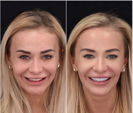 Snap-On Veneers Set for Upper & Lower Teeth with Custom Fit | Removable Solution for a Natural-Looking Smile 4