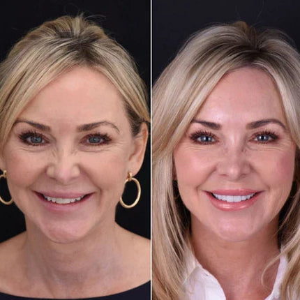 Snap-On Veneers Set for Upper & Lower Teeth with Custom Fit | Removable Solution for a Natural-Looking Smile 7