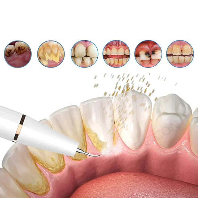 Ultrasonic Tooth Cleaner | Rechargeable Dental Cleaner with Ergonomic Design | Effective Teeth Stain Remover for Home Oral Hygiene 1