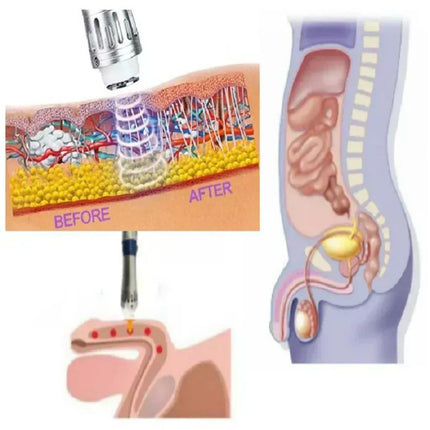 Extracorporeal Shockwave Therapy Device – image 11