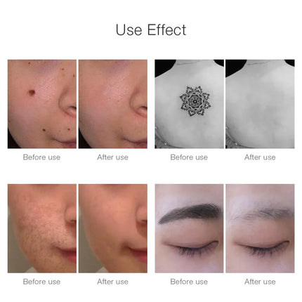 Dark Spot Remover Laser Pen, Tattoo Removal Machine for Professional Use