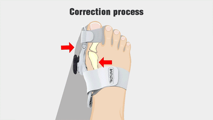 Toe Straightener for Bunions, Adjustable Big Toe Aligner Brace for Both Feet – image 5